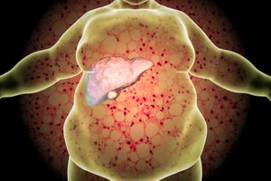 What are the Symptoms, Causes And Treatment of Fatty Liver
